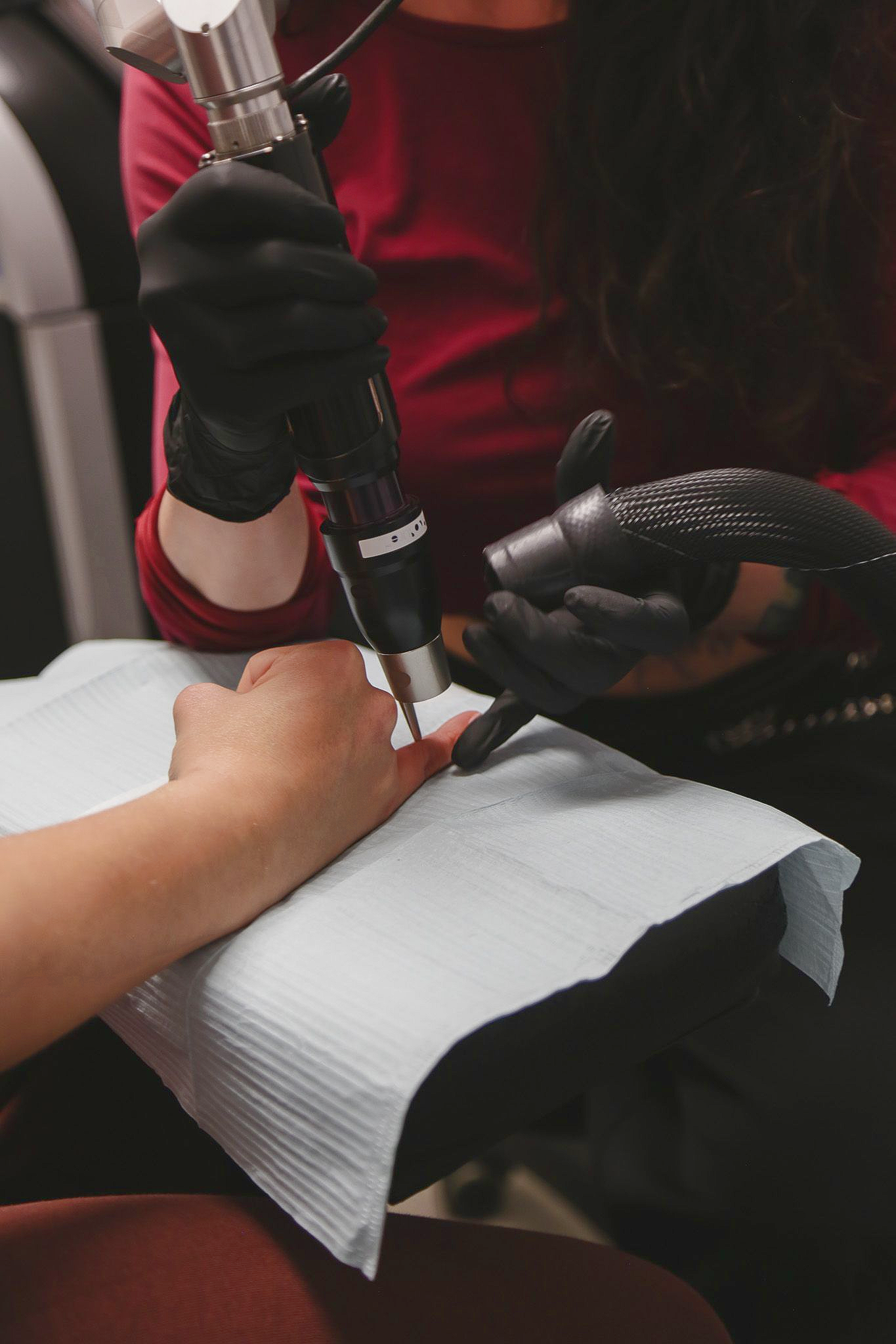 Person receiving laser tattoo removal on a finger. A dark-gloved hand holds laser device; another hand holds a suction hose.