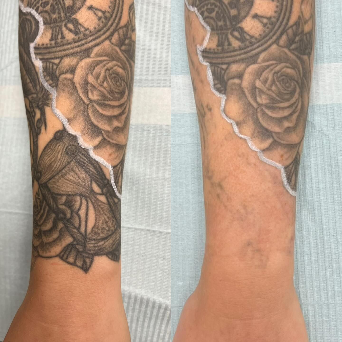 Tattoo on forearm, before and after laser removal: clock, roses, hourglass. Skin shows faded ink.