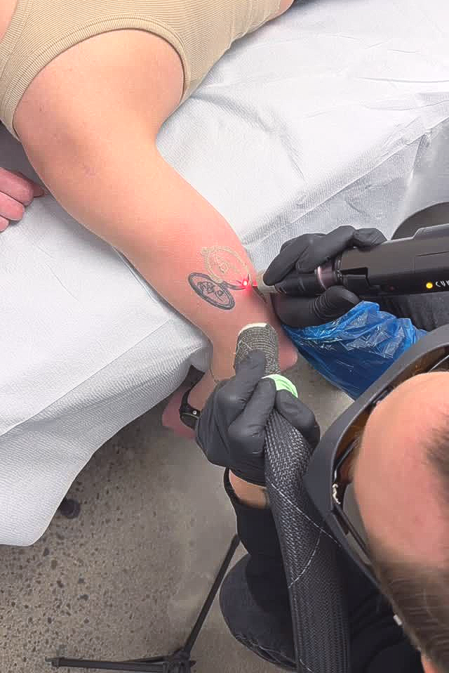 A person's forearm on a medical table receiving laser tattoo removal. A gloved hand uses the laser device.