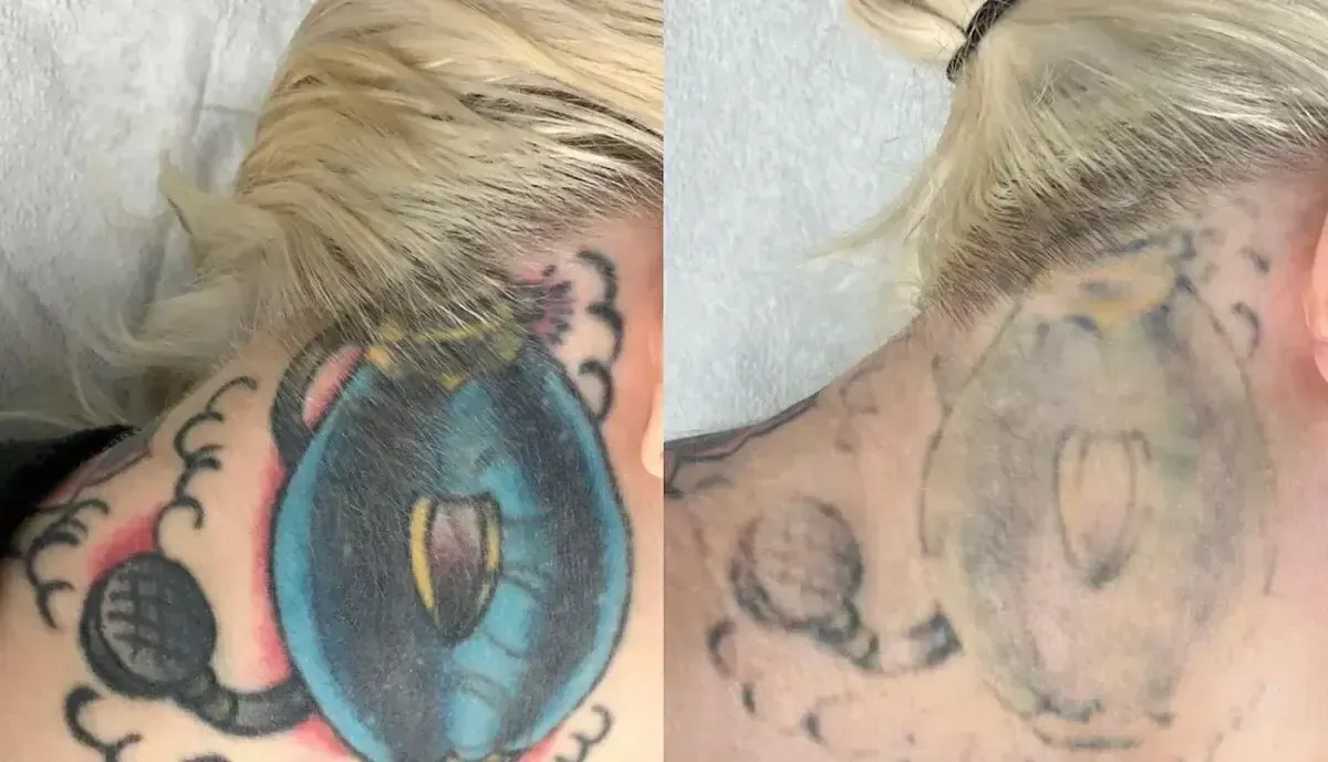 Before-and-after comparison of a blue tattoo on the neck being faded by laser treatment.