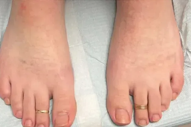 Two feet with toe rings, on a medical examination table; slight redness.