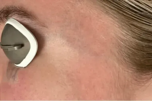 Person's eye with a device over it, possibly for eye treatment. White, gray, and tan colors are visible.