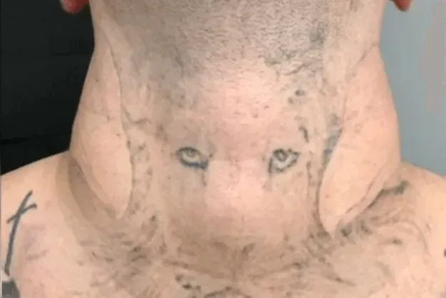 Tattooed neck; two eyes tattooed near the throat. Skin appears swollen and discolored.