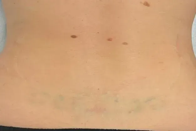 Back with three moles and a faded lower back tattoo.