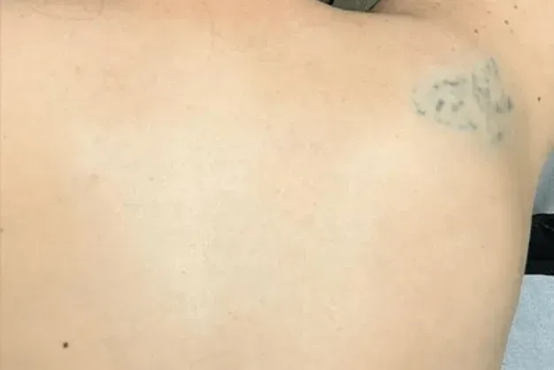 Chest with faded black tattoo on right side.