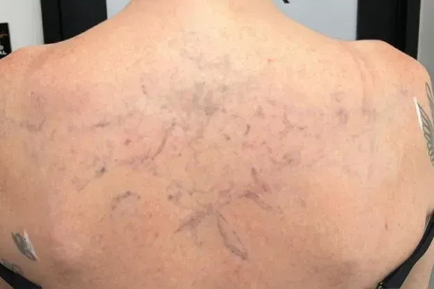 Person's bare back with dark markings, possibly temporary tattoos or skin art, with tape on shoulders.