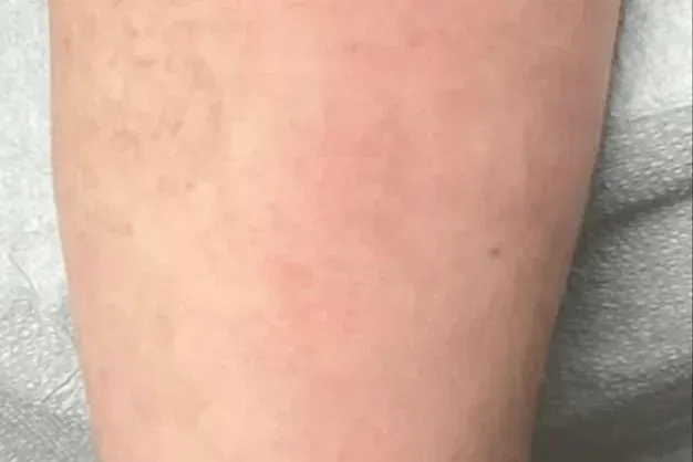 Close-up of human skin, light pink with visible texture.