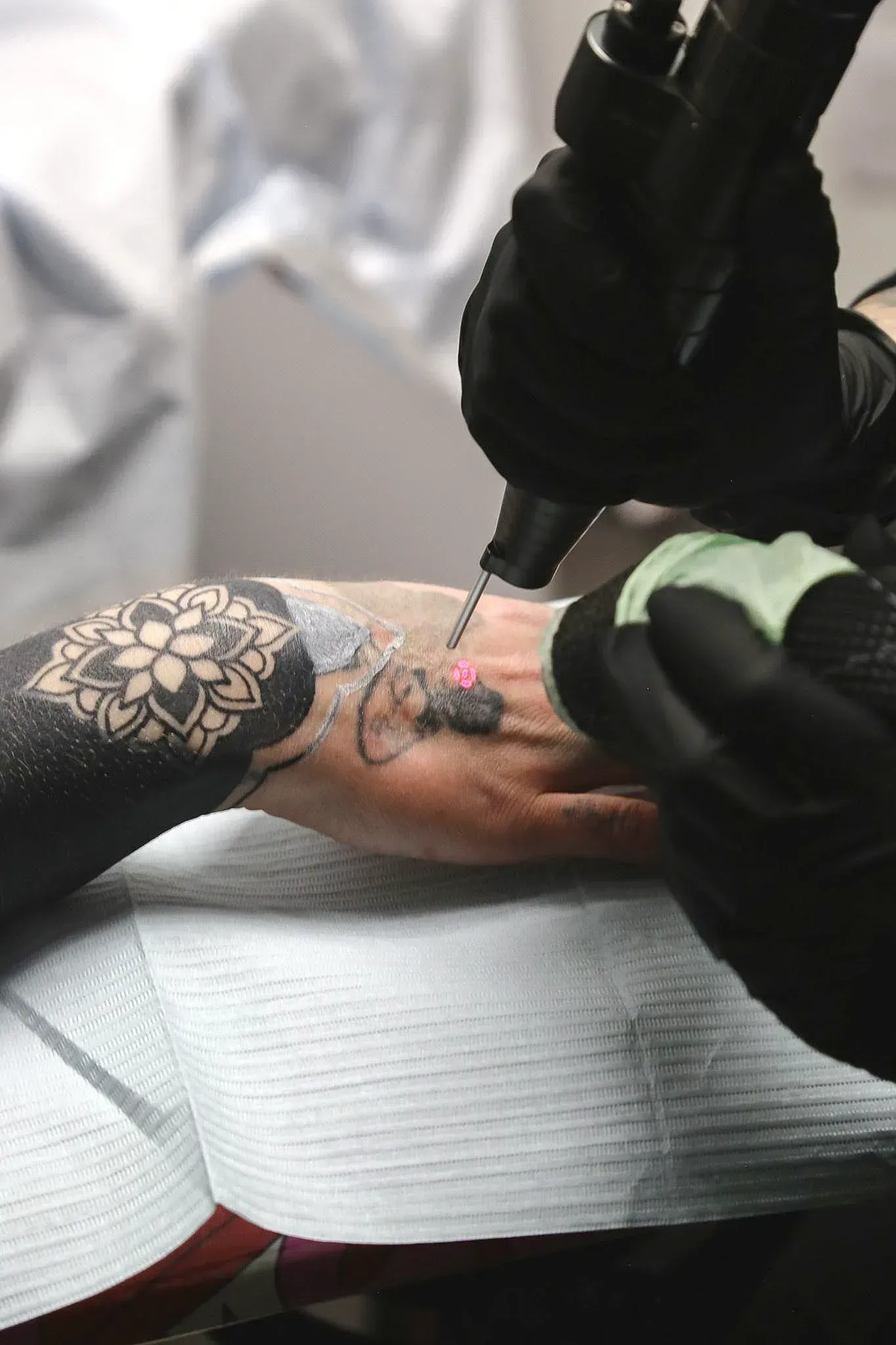 Tattoo removal process on a person's hand, laser device pointed at a small tattoo. Black ink on forearm.