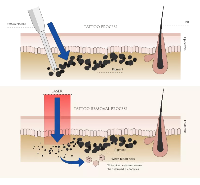 Side-by-side skin diagrams comparing tattooing process and laser tattoo removal process.