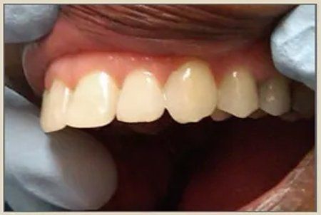 After Dental Treatment — Columbia, SC — University Dental PA