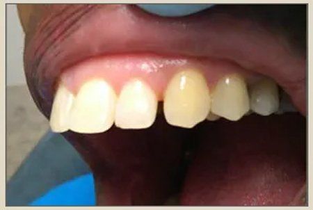 Before Dental Treatment — Columbia, SC — University Dental PA