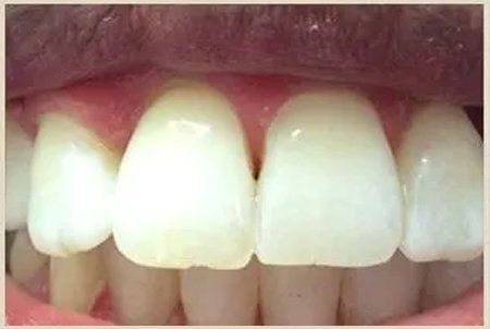 After Braces — Columbia, SC — University Dental PA