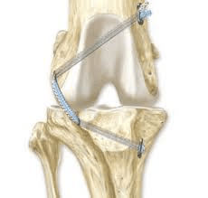 ligament replacement example