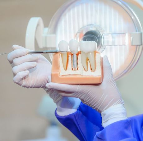 A dentist is holding a model of a tooth with a screw in it.