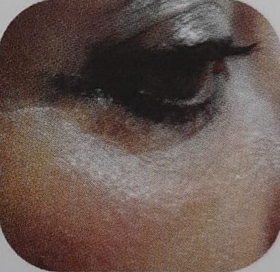 Ringiovanimento Periorbiculare