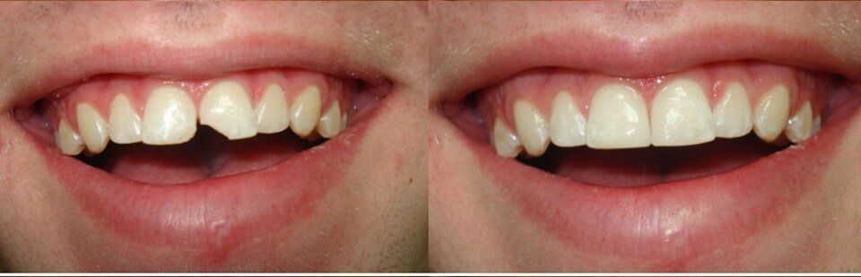 Before and After 10 — General Dentistry in Tallahassee, FL
