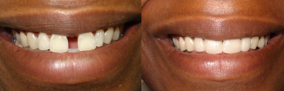 Before and After 9 — General Dentistry in Tallahassee, FL