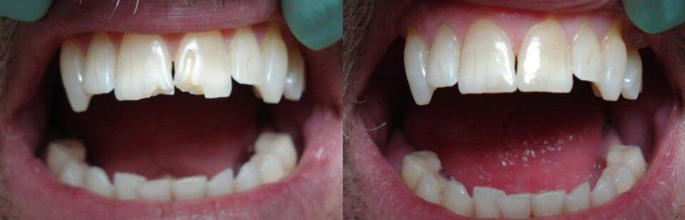 Before and After 7 — General Dentistry in Tallahassee, FL
