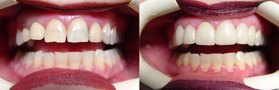 Before and After 6 — General Dentistry in Tallahassee, FL