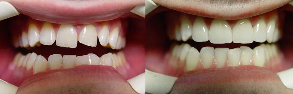 Before and After 4 — General Dentistry in Tallahassee, FL