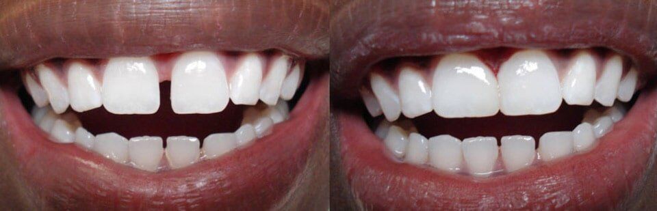 Before and After 2 — General Dentistry in Tallahassee, FL