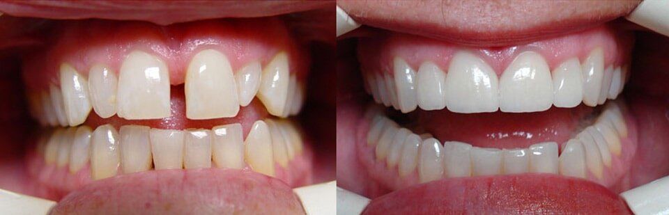 Before and After 1 — General Dentistry in Tallahassee, FL