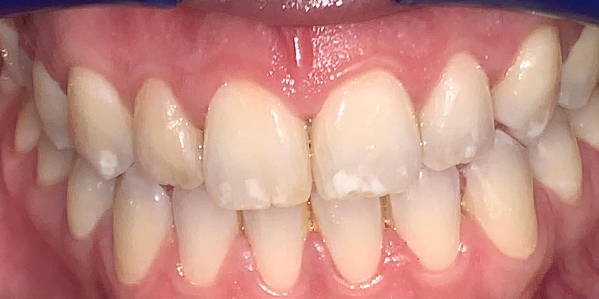 Close-up of a person's teeth, showing the upper and lower teeth with some discoloration and white spots.