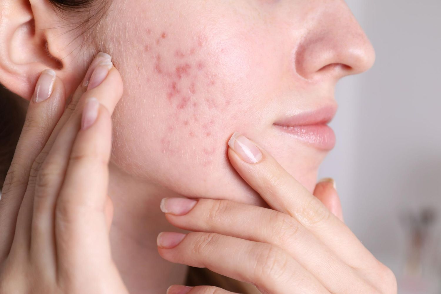 Woman touching cheek with acne scars.