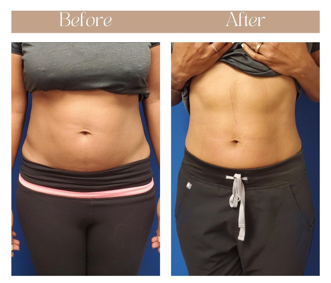 A before and after photo of a woman 's stomach