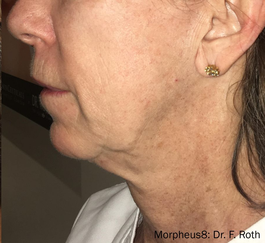 Profile view of a person with neck and face skin changes, possibly after a cosmetic procedure.