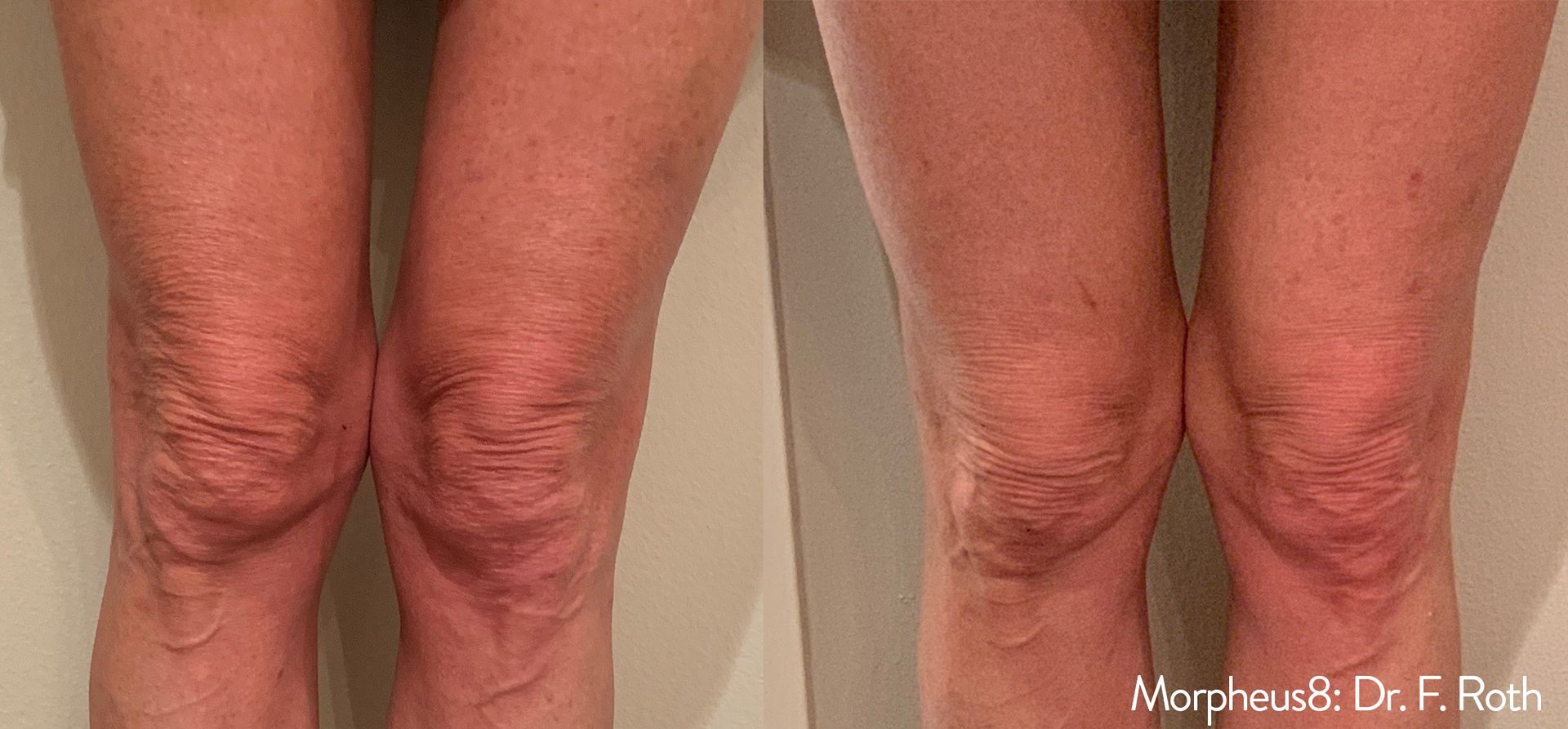 A woman 's legs are shown before and after a knee surgery.
