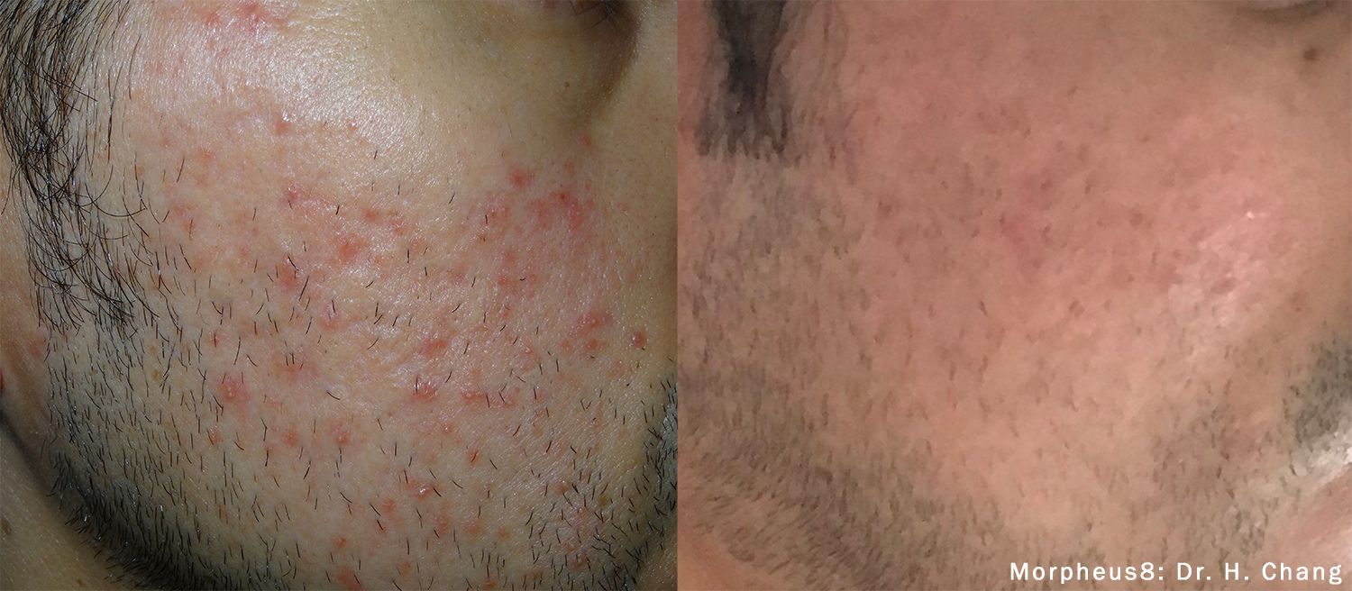A man with a beard has acne on his face.