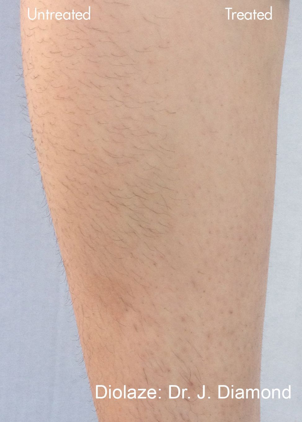 A picture of a person 's leg before and after being treated with diolaze