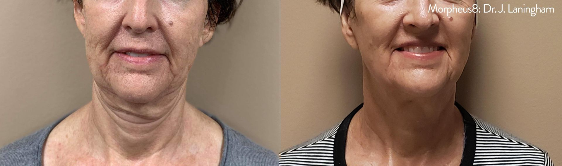A before and after photo of a woman 's neck and face.