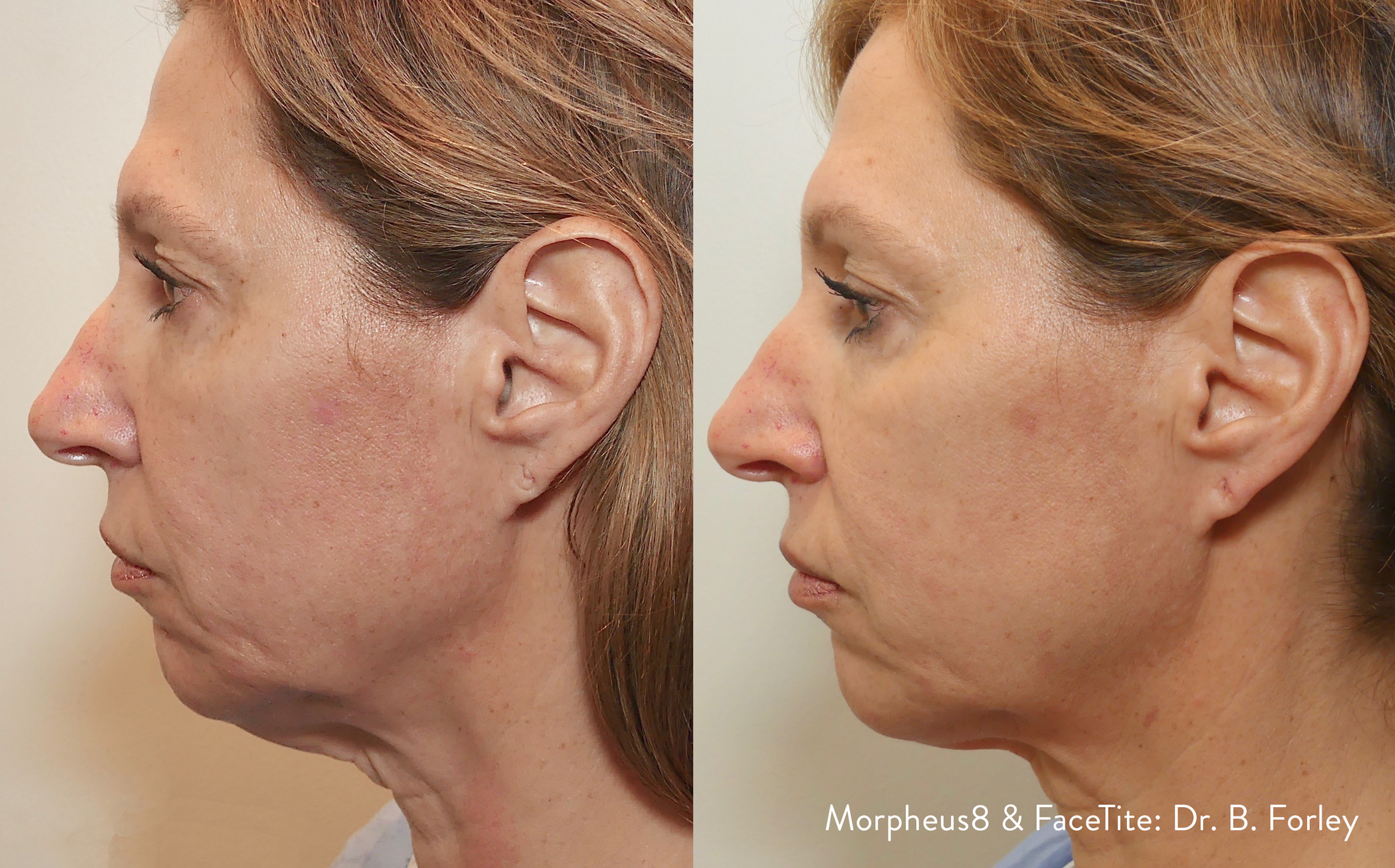 A before and after photo of a woman 's neck and face.