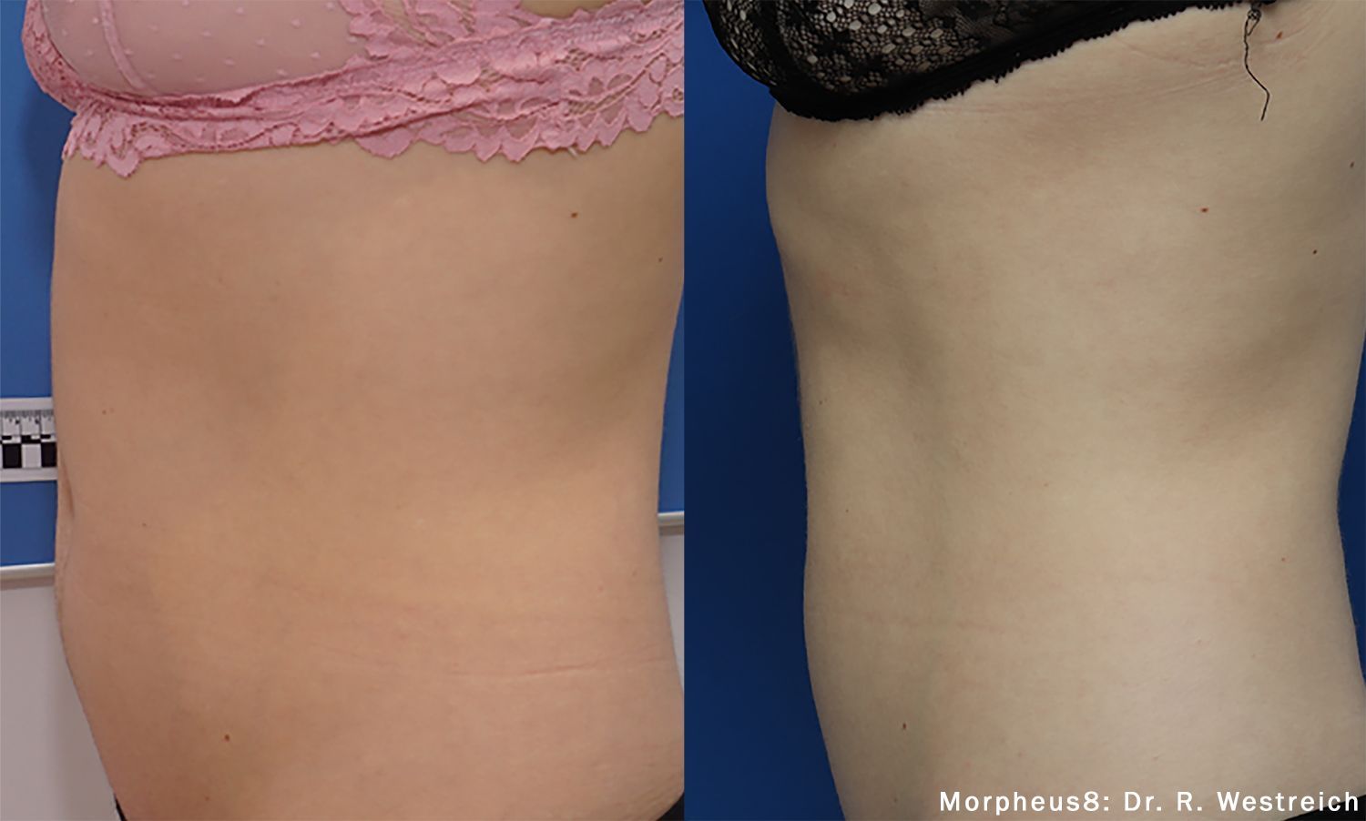 A before and after photo of a woman 's stomach in a pink bra.
