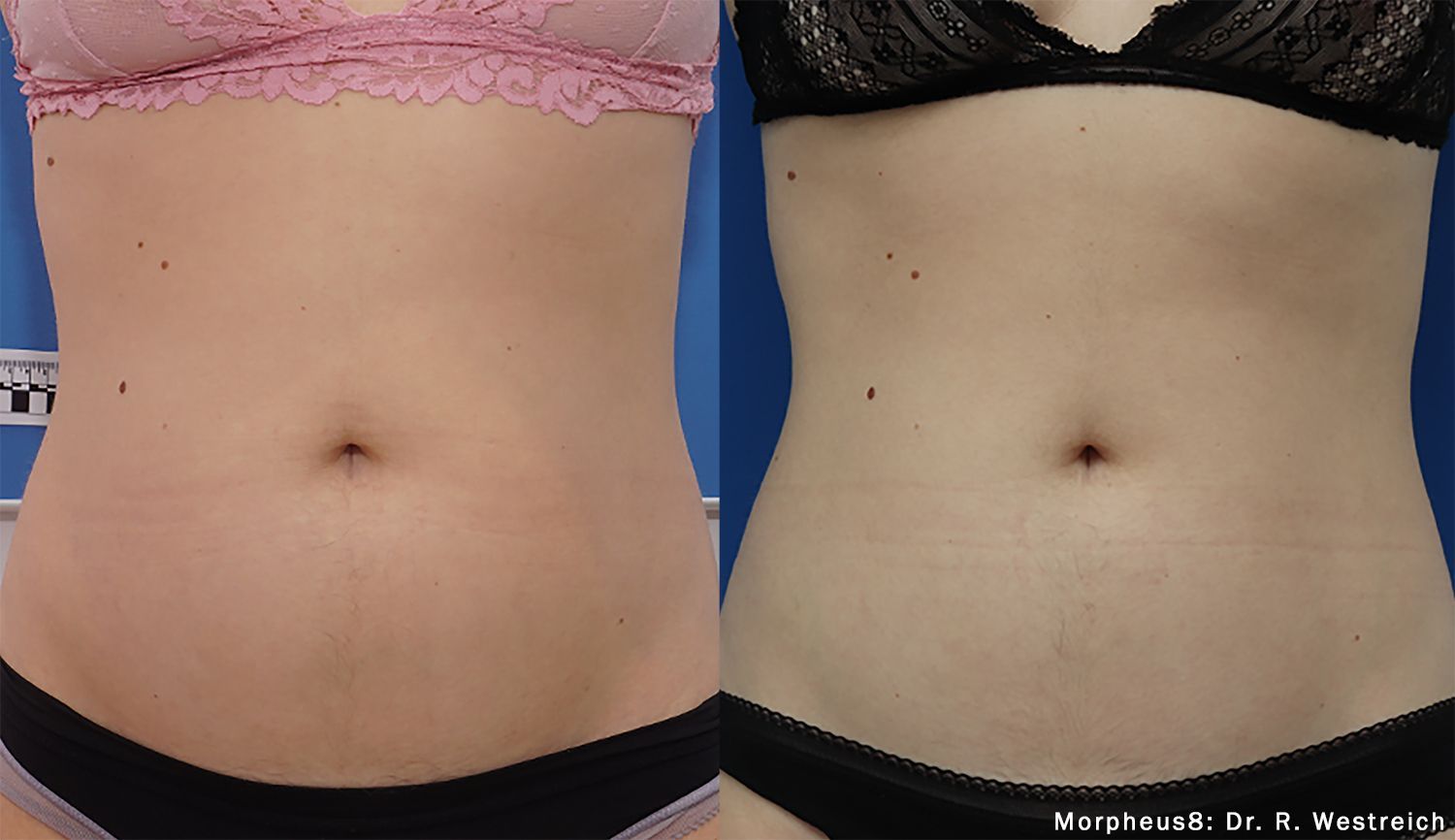 A before and after picture of a woman 's stomach.