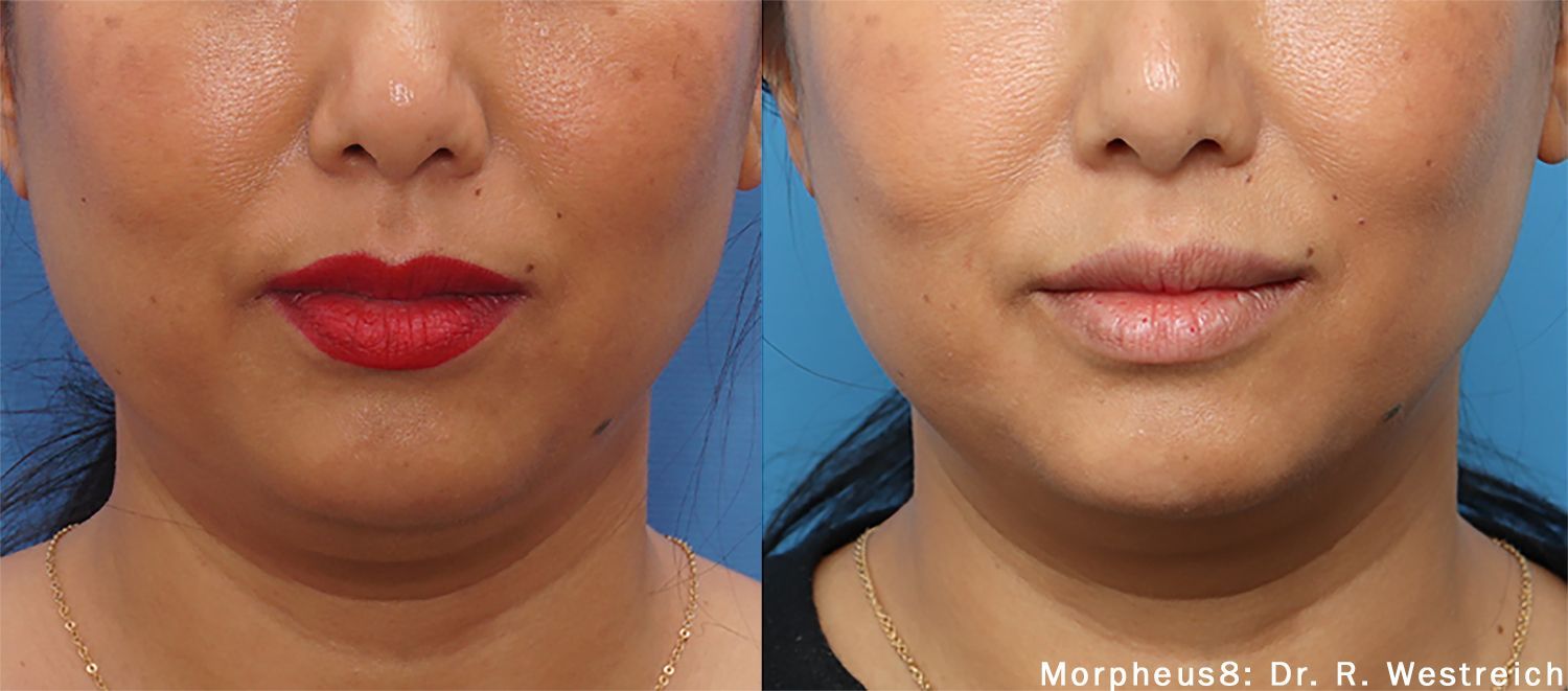A before and after photo of a woman 's face with red lipstick.