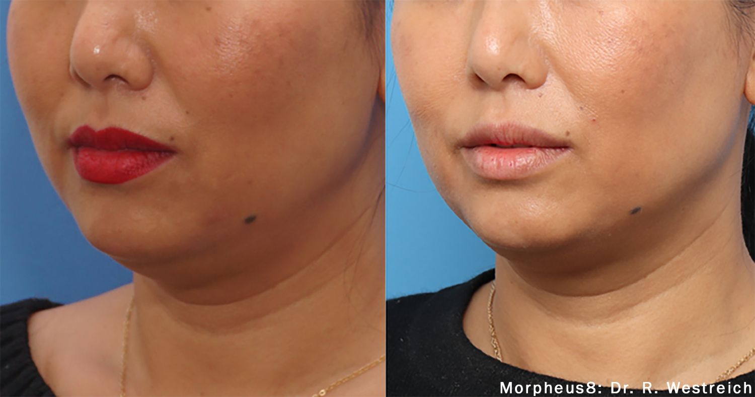 A before and after photo of a woman 's face and neck.