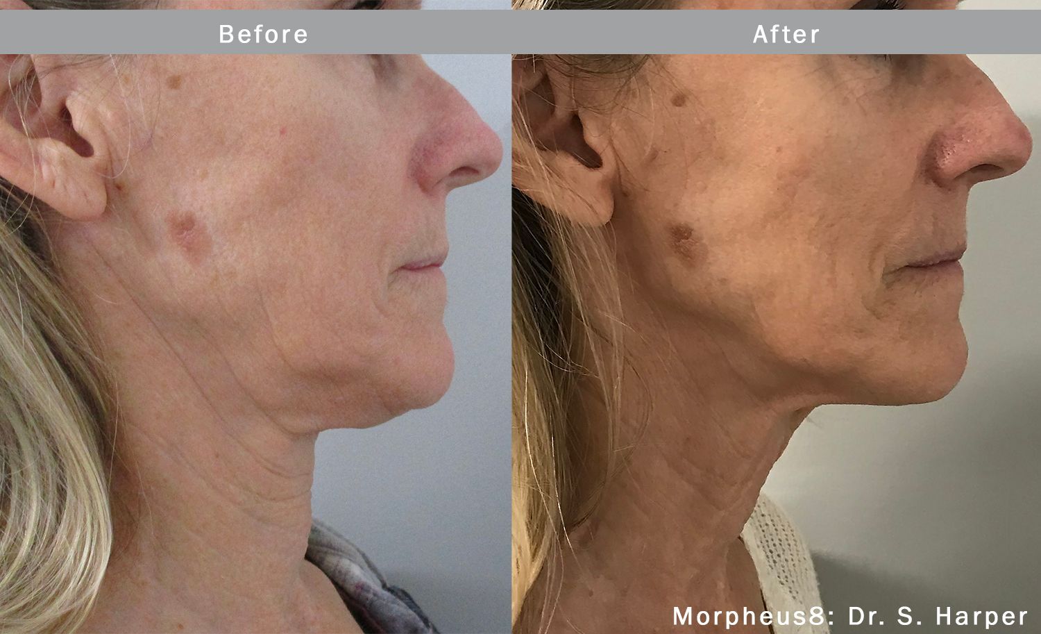 A before and after photo of a woman 's face and neck.