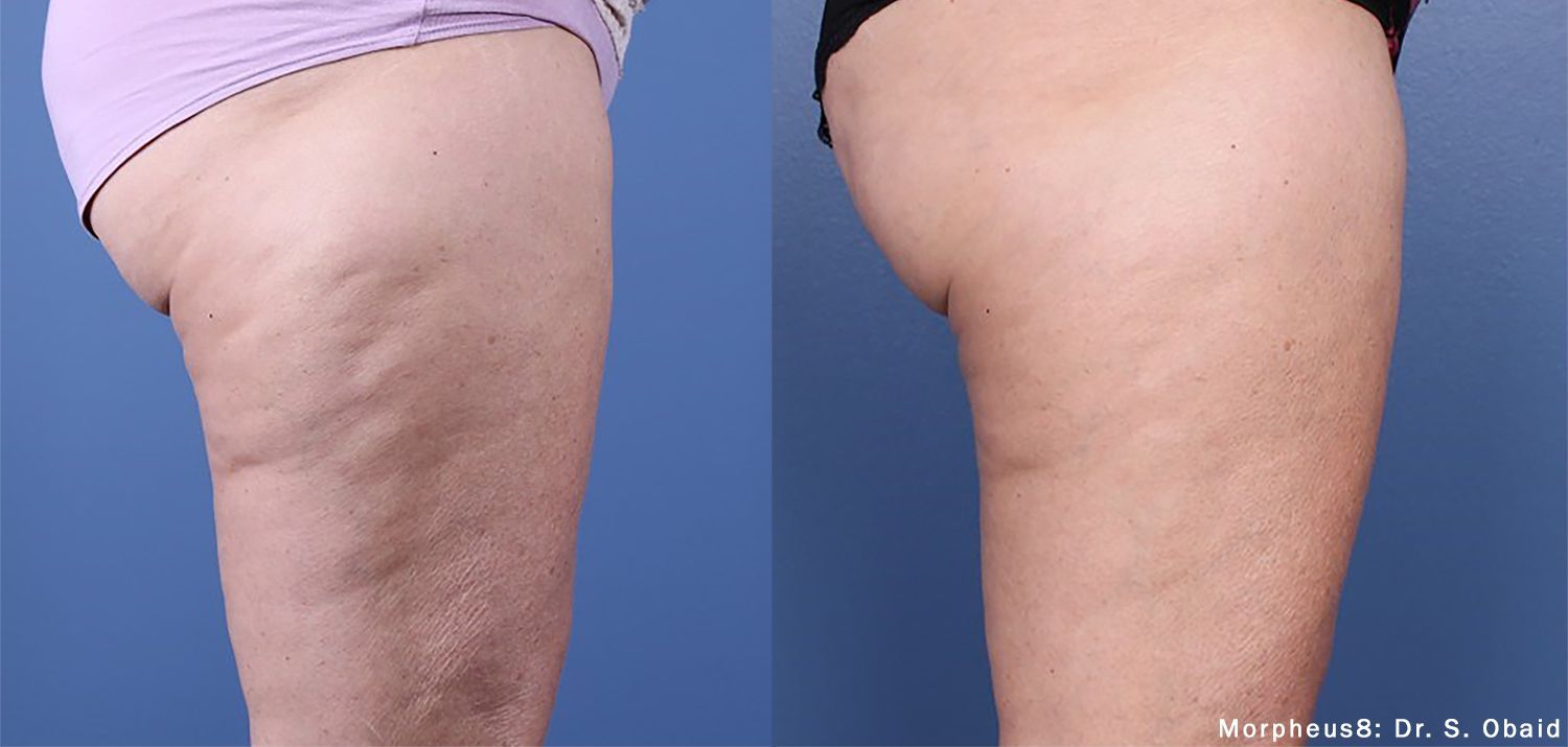 A before and after photo of a woman 's legs with cellulite