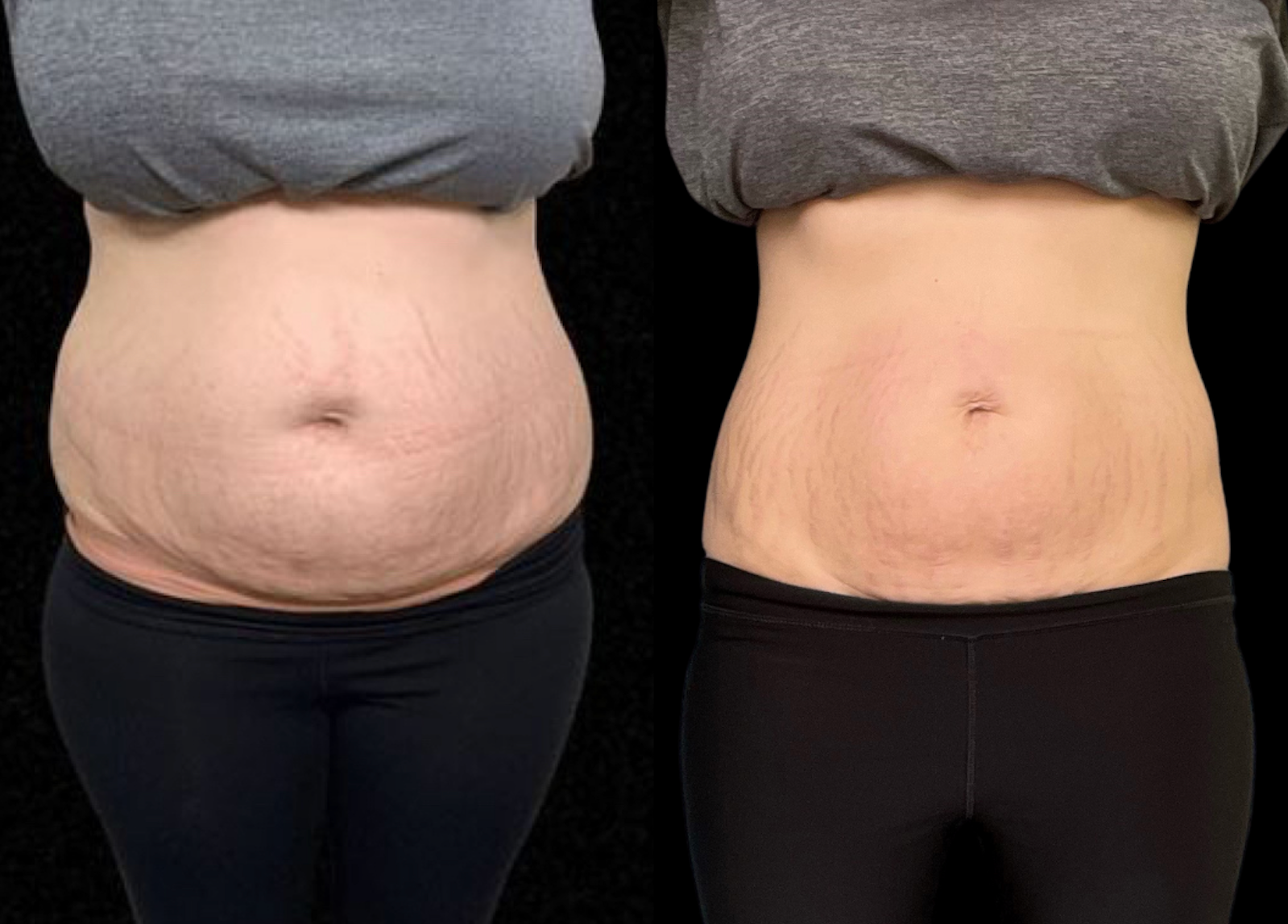 A before and after photo of a woman 's stomach.