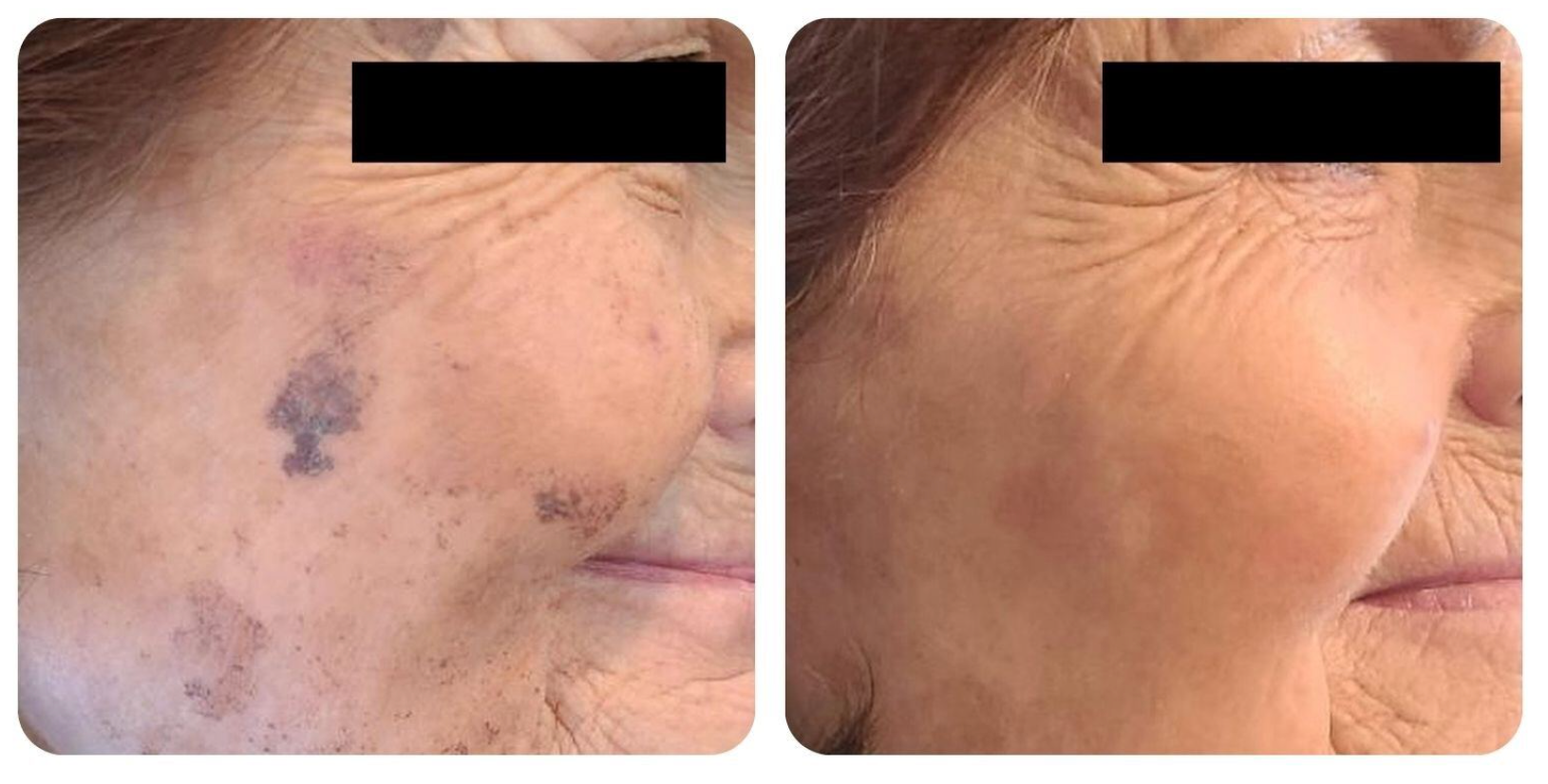 A before and after photo of a woman 's face.