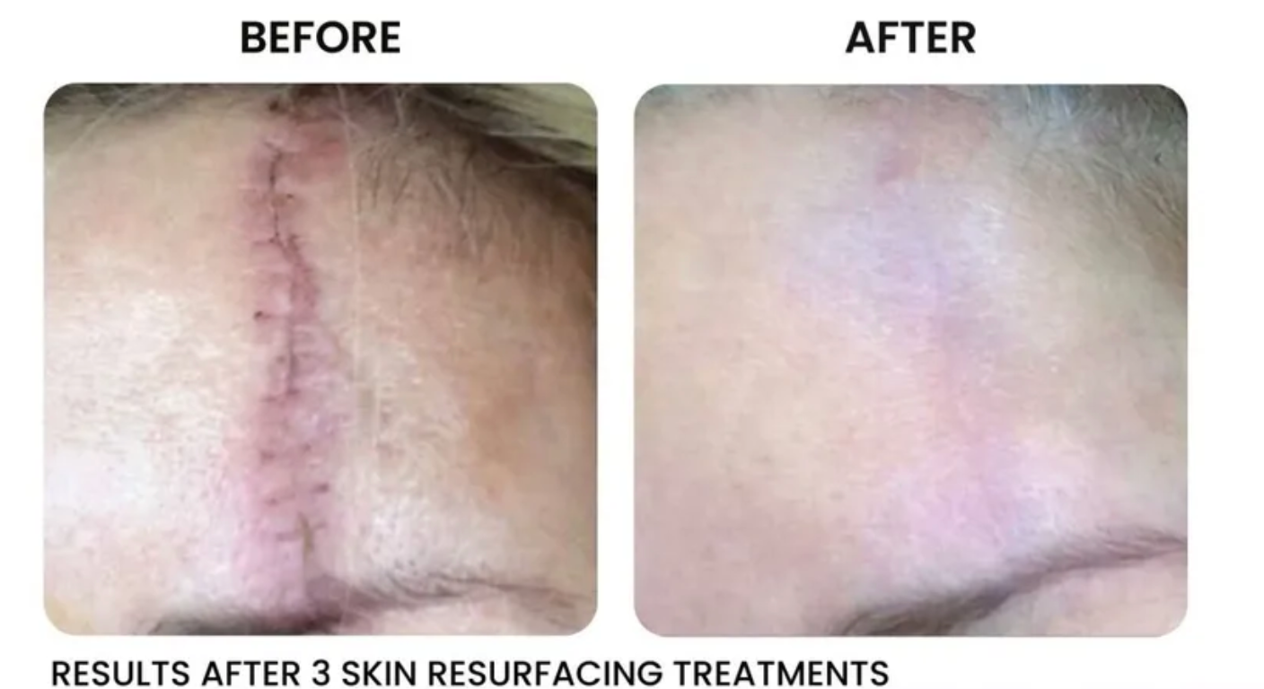 A before and after photo of a person 's face with a scar