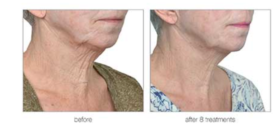 A woman 's neck is shown before and after a treatment.