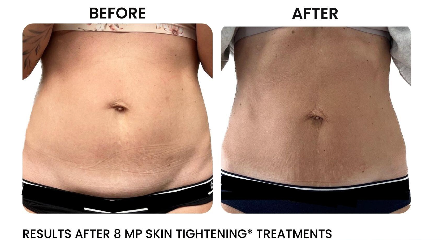 A before and after picture of a woman 's stomach