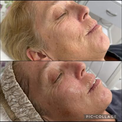Side-by-side facial comparison: Before and after. Older woman with wrinkles, skin refreshed, in spa setting.