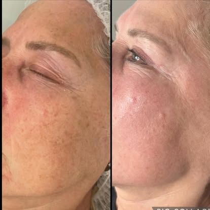 Before-and-after facial skin comparison: woman's face showing reduction of dark spots and redness after treatment.