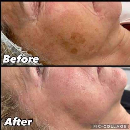 Side-by-side comparison: before and after skin treatment. Dark spots visible before, reduced and lighter after.