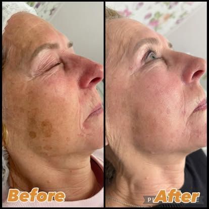 Side-by-side comparison of a woman's face, showing before (left) and after (right) skin treatment, reducing age spots.